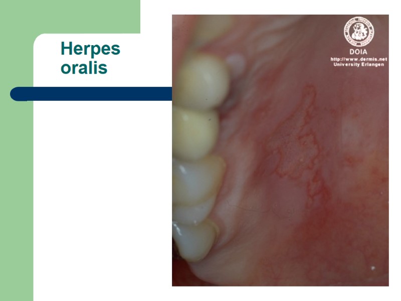 Herpes     oralis
